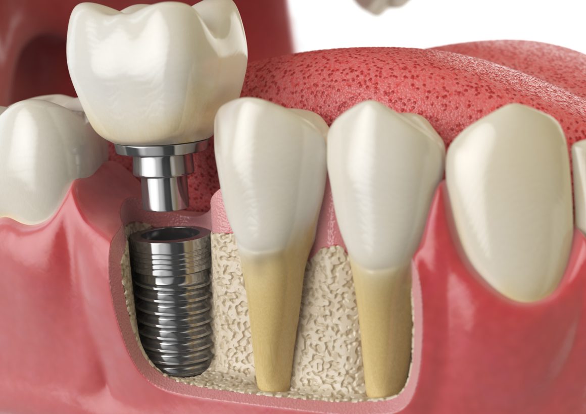 anatomy-of-healthy-teeth-and-tooth-dental-implant-2021-08-26-16-56-57-utc Diş İmplantı