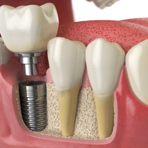 anatomy-of-healthy-teeth-and-tooth-dental-implant-2021-08-26-16-56-57-utc Diş İmplantı